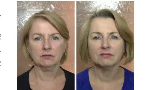 Przed i po zabiegu: zmniejszenie obrzęku limfatycznego i limfy pod oczami, poprawa konturu twarzy.