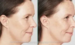 Przed i po zabiegu skin booster. Widoczna poprawa nawilżenia i redukcja drobnych zmarszczek na skórze.