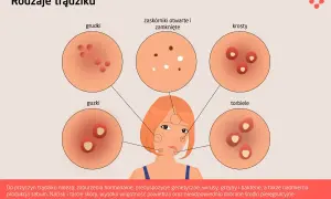 Ilustracja przedstawia różne rodzaje pryszczy: grudki, zaskórniki, krosty, guzki i torbiele, ukazując ich wygląd.