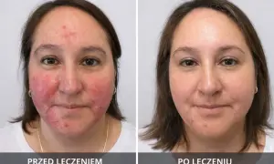 Przed i po leczeniu: skóra twarzy z zaczerwienieniem i wypryskami, a następnie wygładzona. Zmiany mogą być powikłania po mezoterapii igłowej.