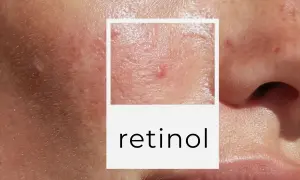 Zbliżenie na skórę z niedoskonałościami, w tym pryszczami i bliznami. W ramce napis "retinol co to".