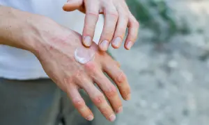 Dłonie z zaczerwienieniem i wysypką, na które nakładany jest krem. Czy to dermatoza?
