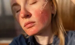 Czerwona, podrażniona skóra twarzy po zastosowaniu serum z niacynamidem. Kobieta zamyka oczy, gdy kropla serum spada z pipety.
