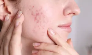 Skóra z zaczerwienieniami i wypryskami, które mogą być objawem fungal acne. Kobieta dotyka policzka.