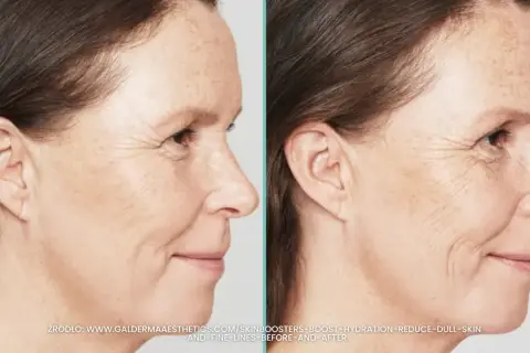 Przed i po zabiegu skin booster. Widoczna poprawa nawilżenia i redukcja drobnych zmarszczek na skórze.