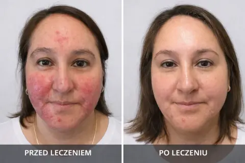 Przed i po leczeniu: skóra twarzy z zaczerwienieniem i wypryskami, a następnie wygładzona. Zmiany mogą być powikłania po mezoterapii igłowej.
