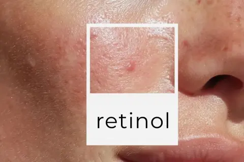 Zbliżenie na skórę z niedoskonałościami, w tym pryszczami i bliznami. W ramce napis "retinol co to".