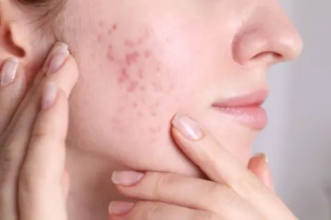 Skóra z zaczerwienieniami i wypryskami, które mogą być objawem fungal acne. Kobieta dotyka policzka.