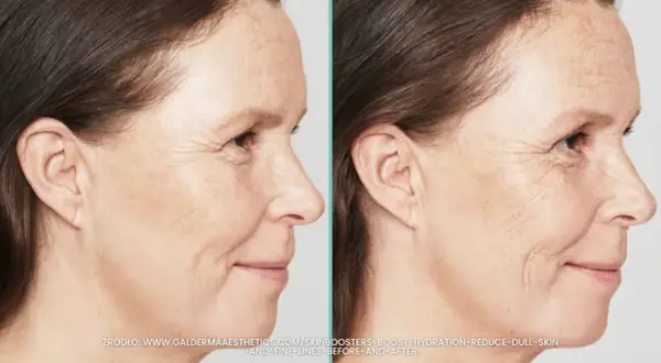 Przed i po zabiegu skin booster. Widoczna poprawa nawilżenia i redukcja drobnych zmarszczek na skórze.
