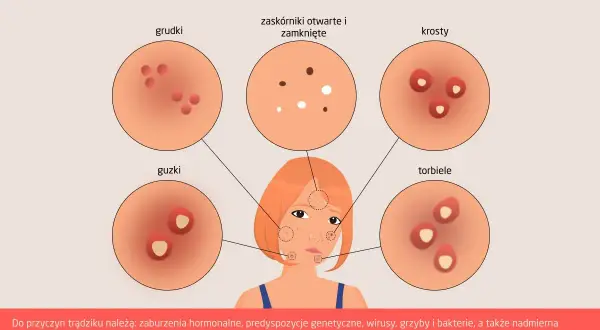 Ilustracja przedstawia różne rodzaje pryszczy: grudki, zaskórniki, krosty, guzki i torbiele, ukazując ich wygląd.