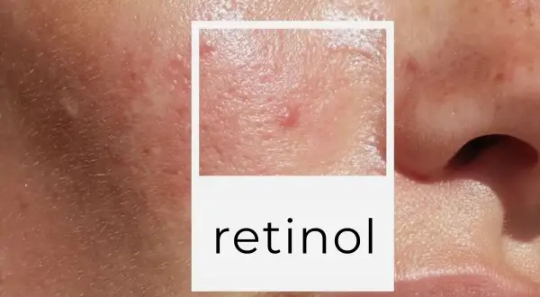 Zbliżenie na skórę z niedoskonałościami, w tym pryszczami i bliznami. W ramce napis "retinol co to".