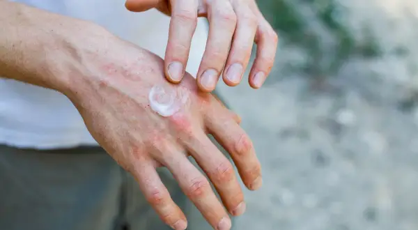 Dłonie z zaczerwienieniem i wysypką, na które nakładany jest krem. Czy to dermatoza?