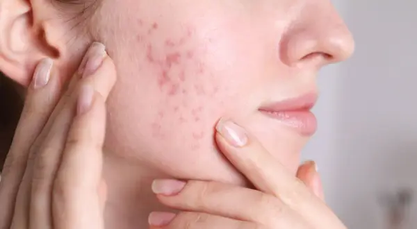Skóra z zaczerwienieniami i wypryskami, które mogą być objawem fungal acne. Kobieta dotyka policzka.