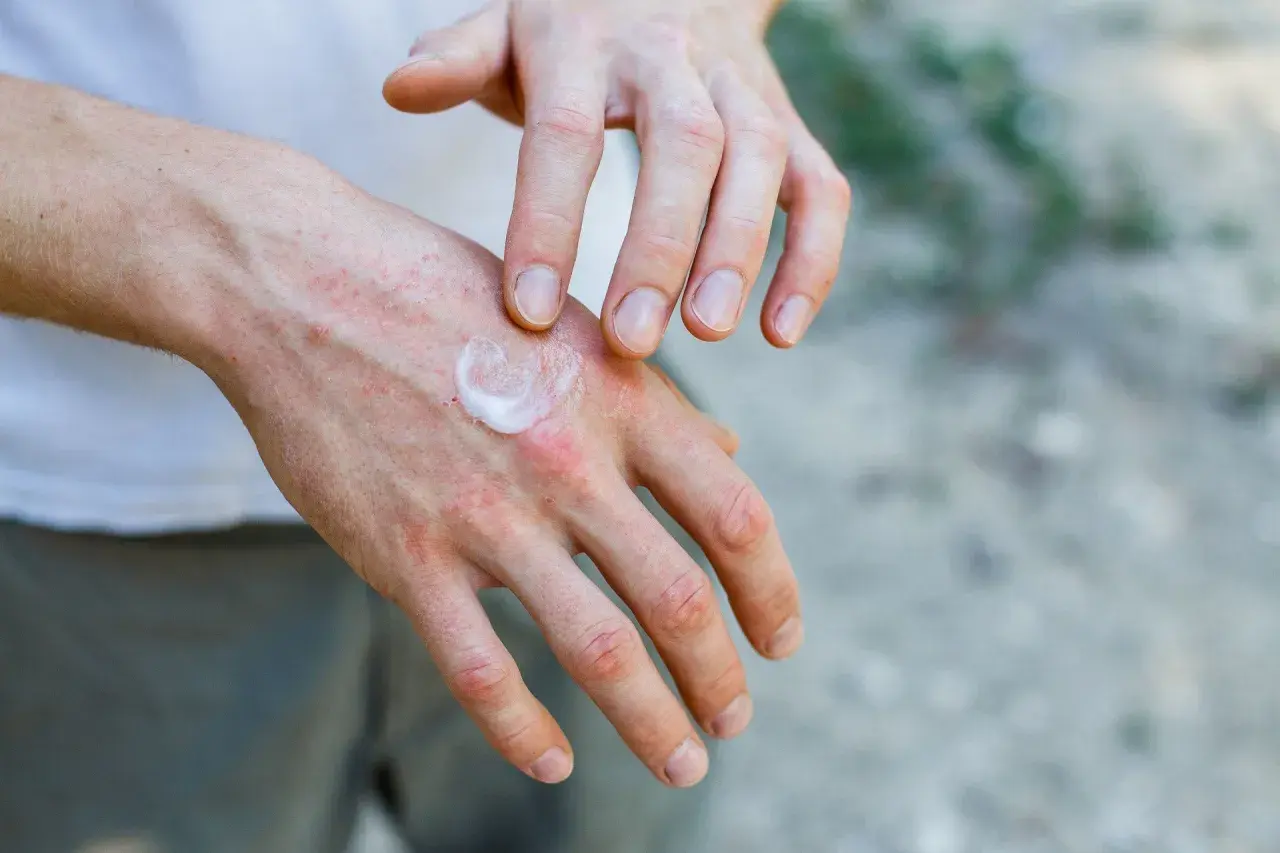 Dłonie z zaczerwienieniem i wysypką, na które nakładany jest krem. Czy to dermatoza?