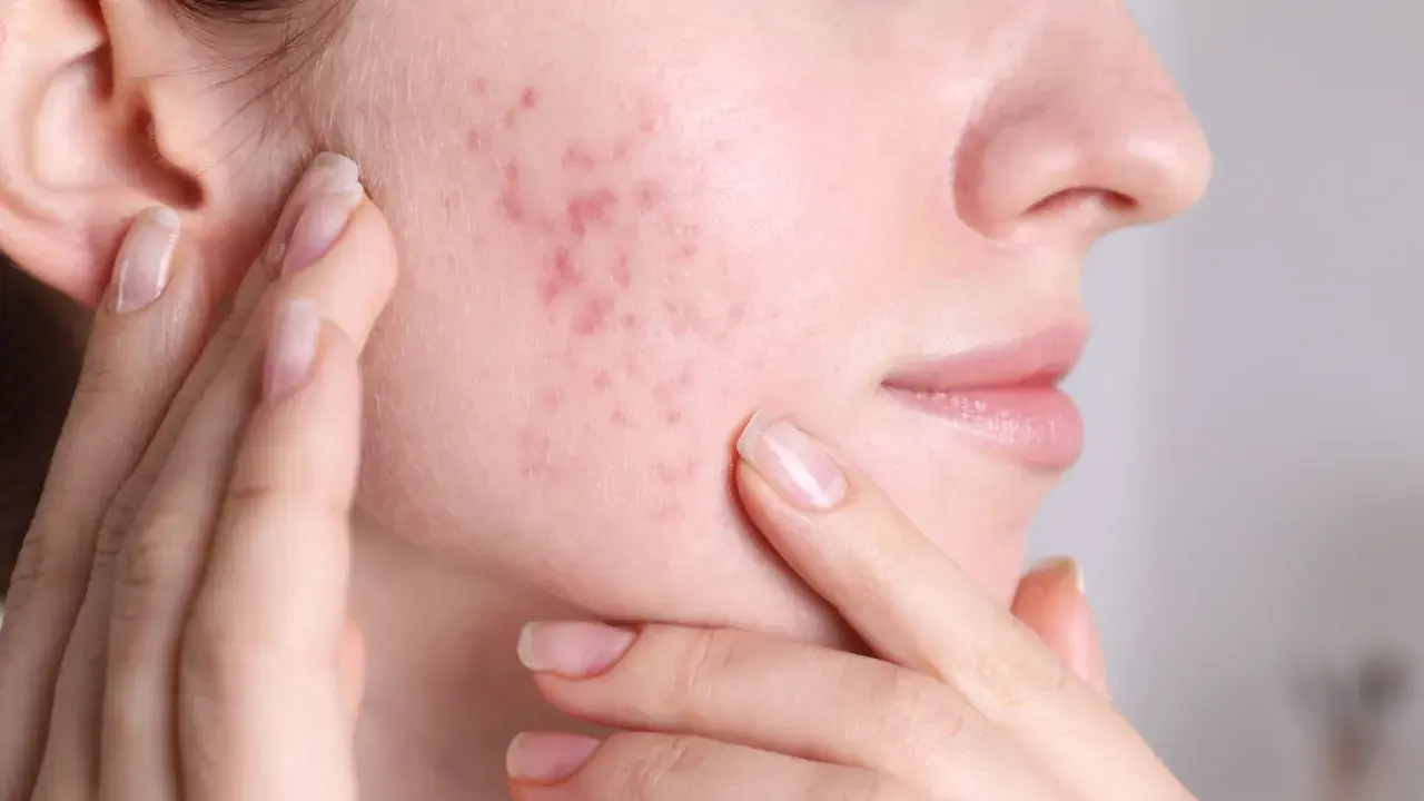 Skóra z zaczerwienieniami i wypryskami, które mogą być objawem fungal acne. Kobieta dotyka policzka.