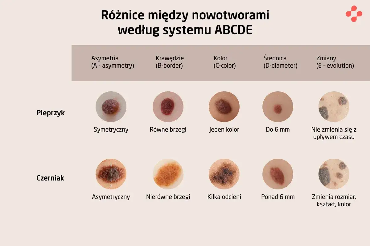Porównanie znamion i czerniaków wg ABCDE. Dowiedz się, co to dermatoza i jak ją rozpoznać.