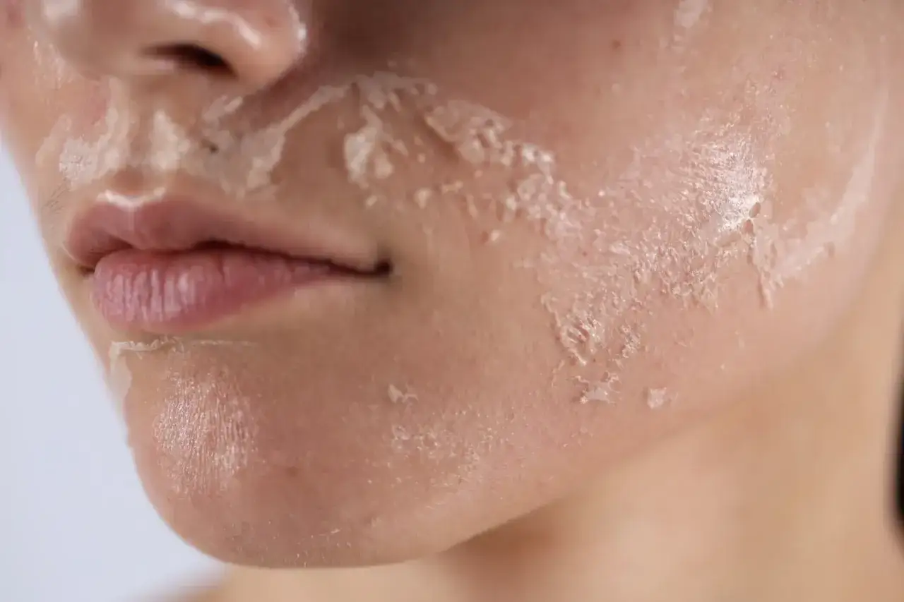 Skóra po zabiegu, widoczne łuszczenie. To właśnie peeling, który odnawia naskórek.
