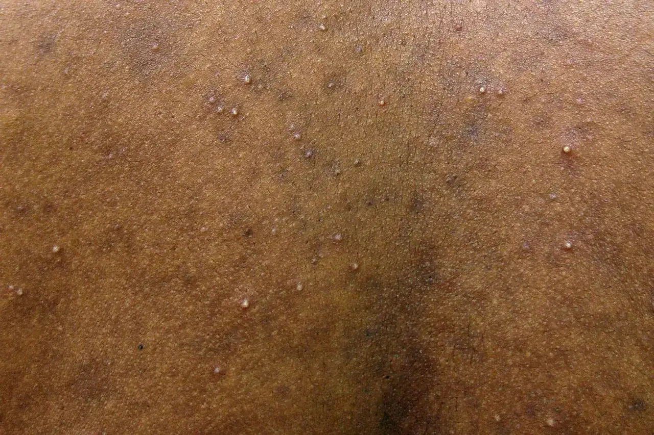 Sk&oacute;ra z licznymi drobnymi, białymi krostkami, przypominającymi objawy grzybicy sk&oacute;ry, czyli fungal acne.
