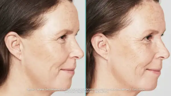 Przed i po zabiegu skin booster. Widoczna poprawa nawilżenia i redukcja drobnych zmarszczek na skórze.