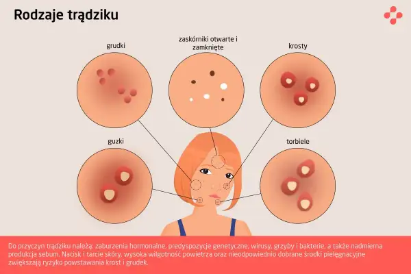 Ilustracja przedstawia różne rodzaje pryszczy: grudki, zaskórniki, krosty, guzki i torbiele, ukazując ich wygląd.
