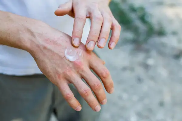 Dłonie z zaczerwienieniem i wysypką, na które nakładany jest krem. Czy to dermatoza?