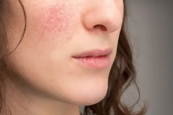 Czerwone plamy na policzku sugerują alergię na twarzy. Skóra jest zaczerwieniona i podrażniona.